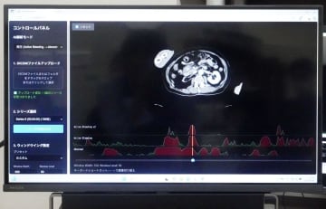 けがCT画像、10秒でAI分析　的確に「止血」、迅速な治療期待