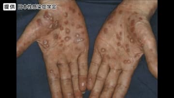 性感染症「梅毒」が全国で急増　SNS、マッチングアプリでの出会いが一因か　地方でも拡大…男性20～40代、女性20～30代に多く　長野県で“過去最多”4年連続更新