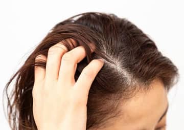 ストレスで髪が抜けるメカニズムを解明…自己免疫が関係