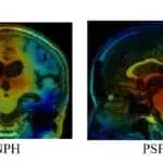 認知症などと見分けにくい「治療可能な病気」を見逃さない画像識別AIを開発