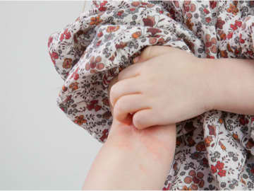 乾燥？アトピー？年代で変わるの？小児外科専門医竹内先生にお伺いしました