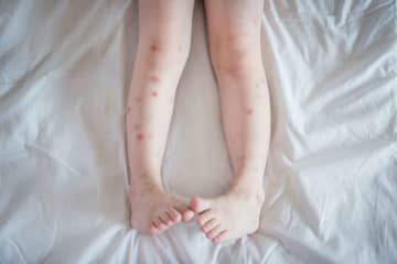 やりすぎると悪化するのに…　蚊に刺されると爪で跡をつける理由　蚊に刺されたところに、爪を立てて跡をつける人がいる。あまり意味のない行為だが、ついやってしまうのだろう。