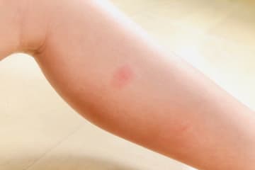 蚊に刺された時の対処法とは？腫れる理由や跡に残さないコツ