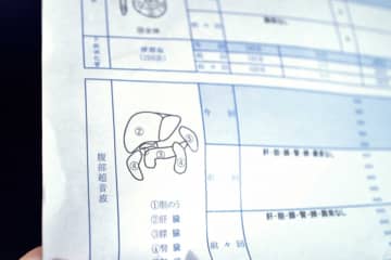 肝硬変や肝炎発症のリスクあり！成人の3分の1が「脂肪肝」持ちの日本人