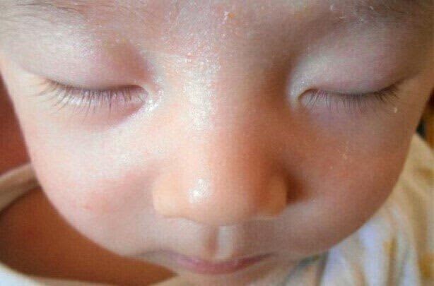 子どもにステロイド剤を使っても大丈夫……？ 薬剤師が徹底解説！