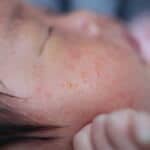 秋生まれは生後6か月以降に湿疹・アトピー性皮膚炎の発症が多い、富山大学が調査