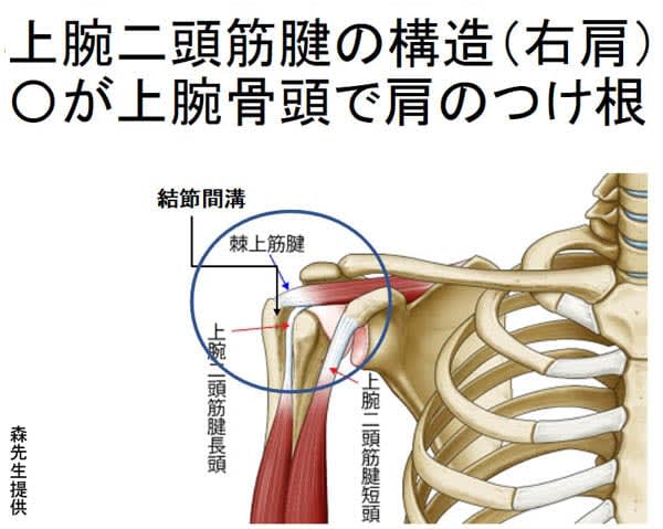 Diagnosis of ``biceps brachii tendon injury'' with persistent shoulder pain is very difficult