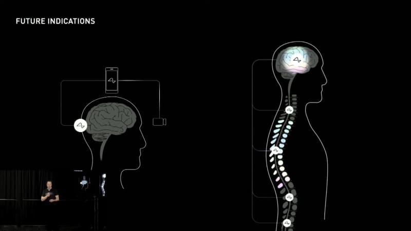 脳にチップ埋め込み ヒトへの臨床試験承認　イーロン・マスク氏ら創設の企業