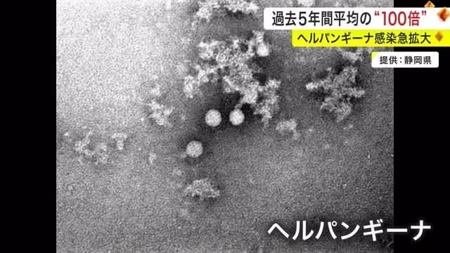 新型コロナ減少も「ヘルパンギーナ感染急拡大」…過去５年間平均の１００倍〈宮城〉　