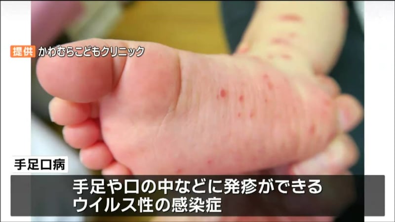 「手足口病」感染者増加し警報出る　新型コロナウイルスは5週連続で減少　宮城