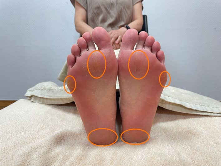 ツラい肩こり・腰痛は「眼精疲労」が原因のことも！　疲れ目を解消する足刺激テクニック