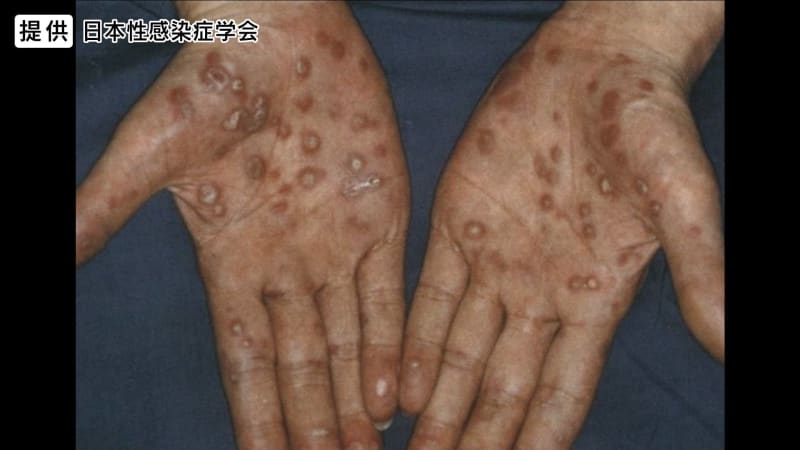 「梅毒」全国で拡大　SNSでの出会い背景か　男性20~50代、女性20代に多い傾向　長野県でも…
