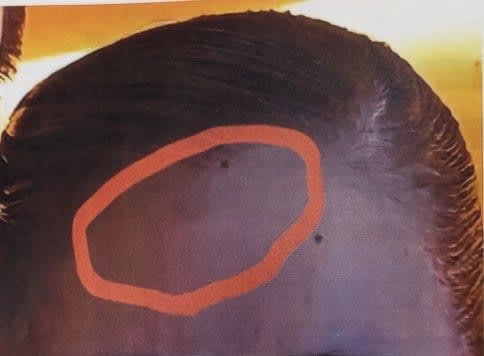 [Breaking News] “It hurt”, the woman who died expressed on SNS, the burn from the curling iron was underestimated, the death of the Takarazuka woman...